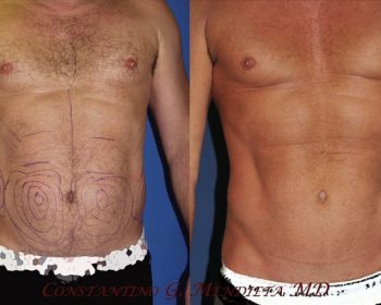 man surgery before and after