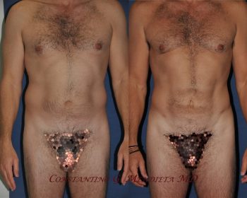 man surgery before and after