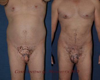man surgery before and after