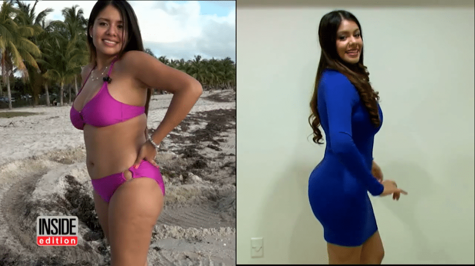 brazilian butt lift surgery in Miami