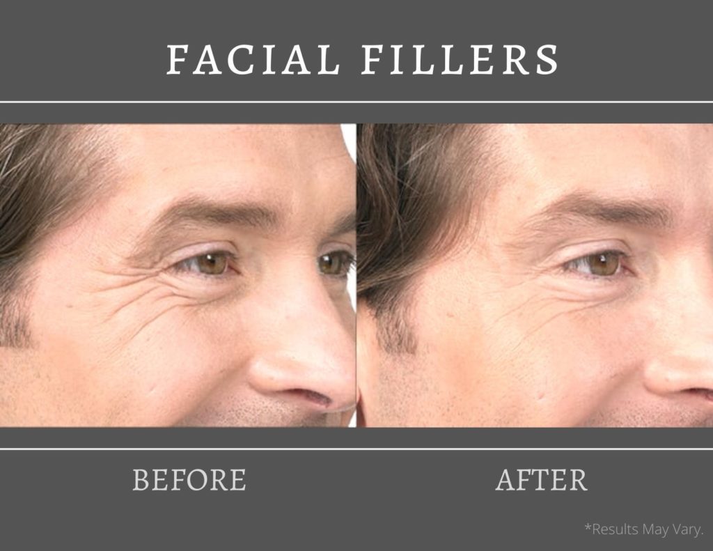 This before-and-after image set shows the effects of facial fillers in reducing "crows feet" wrinkles around the eyes.