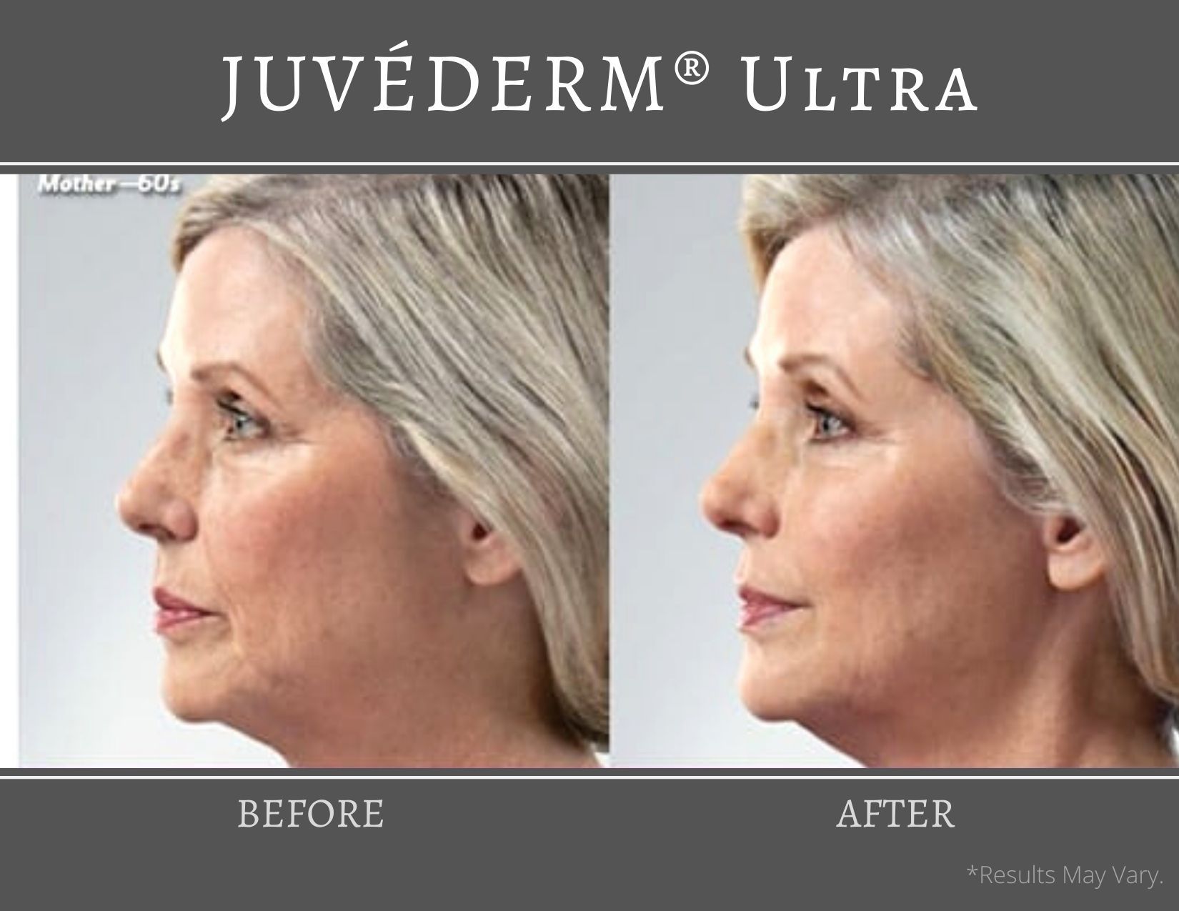 A mother in her 60s and the visible effects before and after receiving JUVEDERM Ultra treatments.