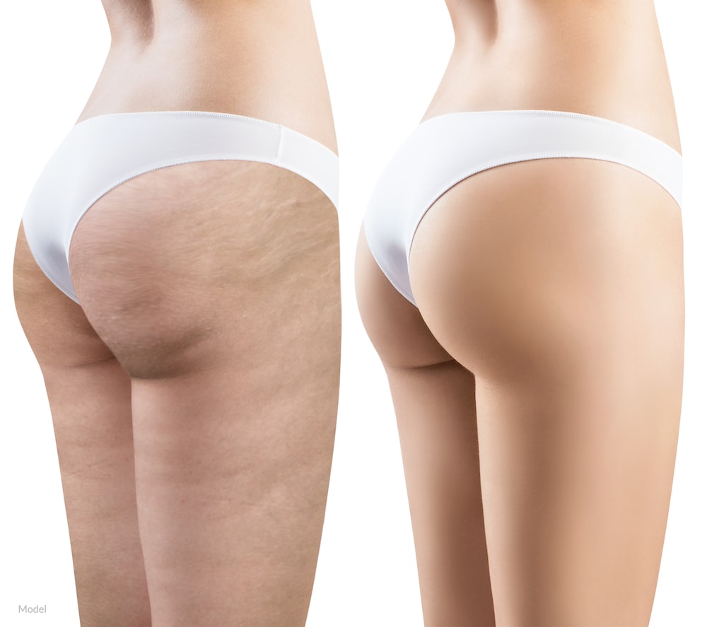 Cellulite transformation before and after.