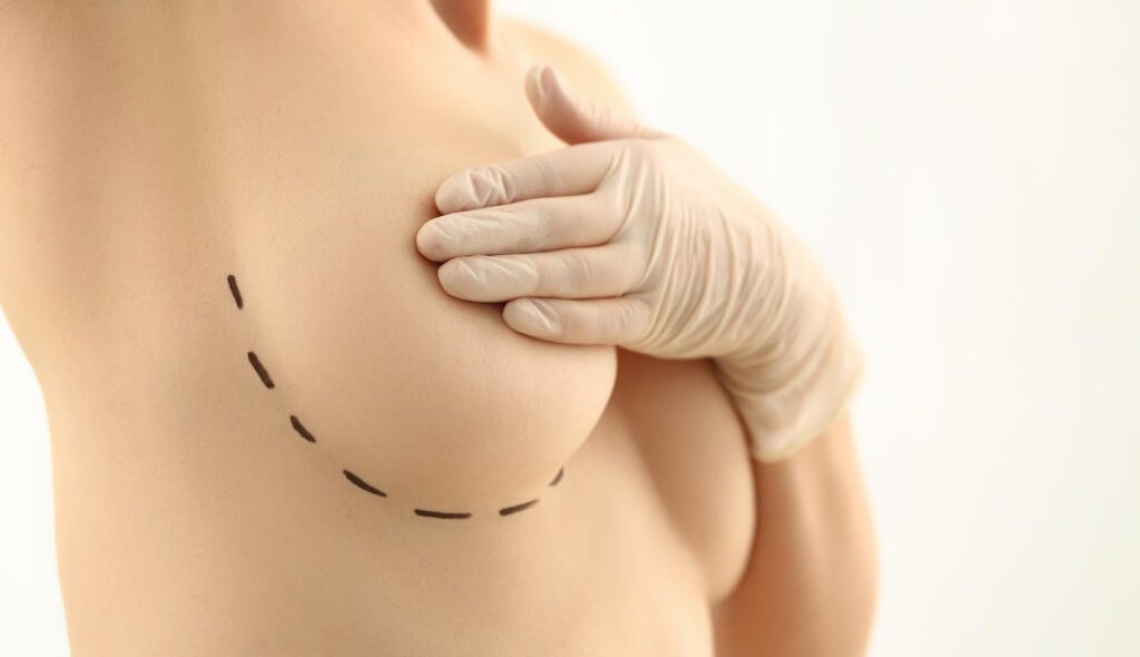 Breast Implant Fat Transfer in Miami