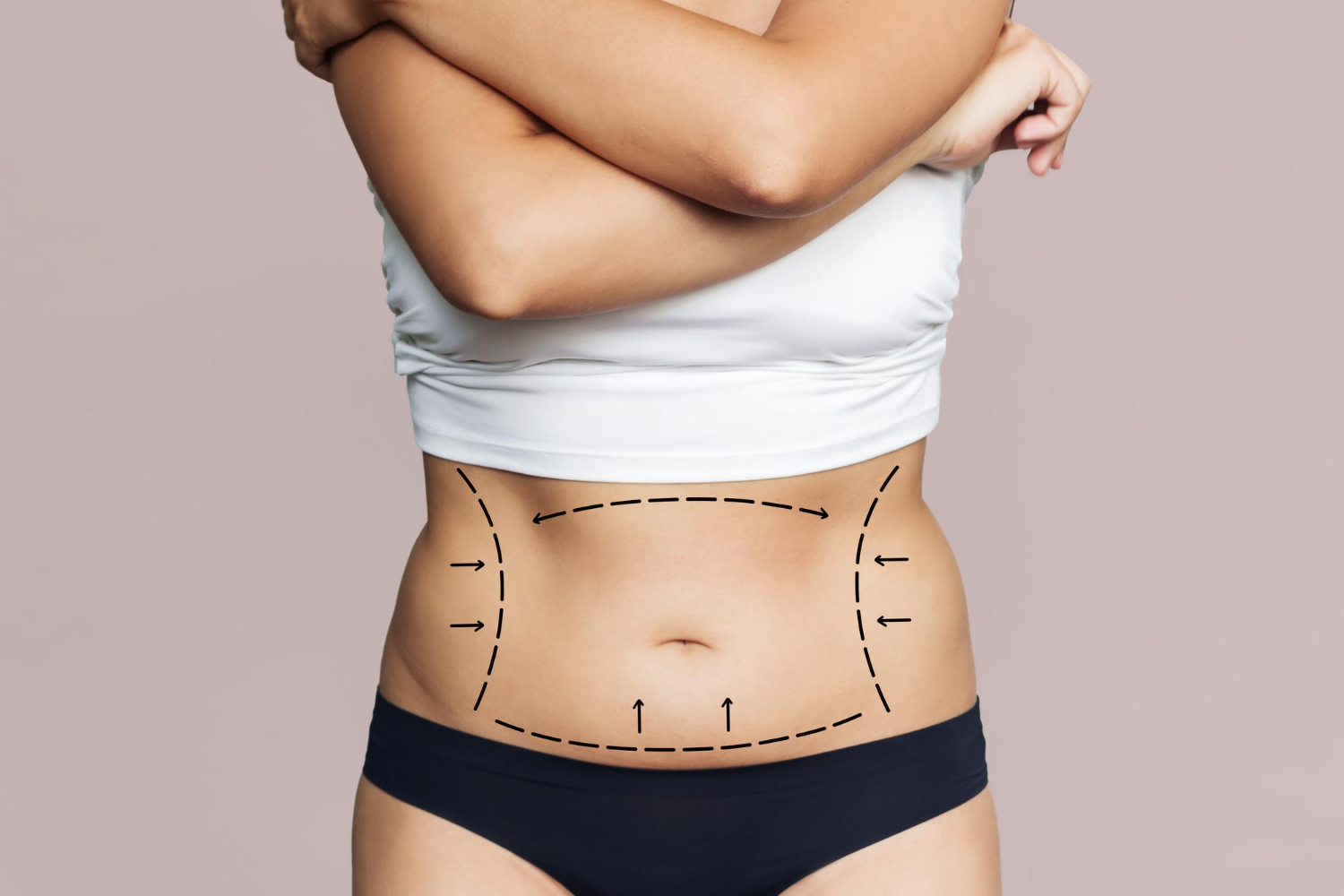 Liposuction with Fat Transfer in Miami