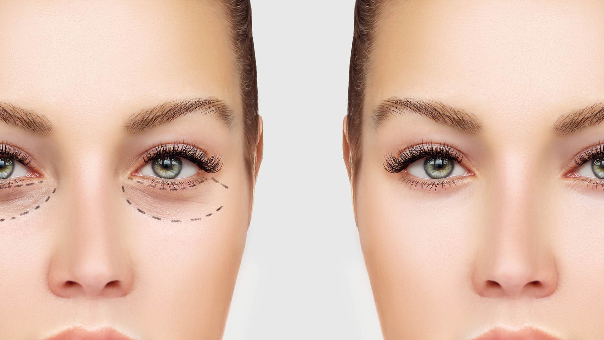 treatments for under eye bags miami